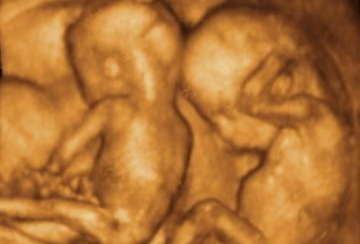 美国CCRH帮客户圆七年未孕之梦成功孕育双胞胎
